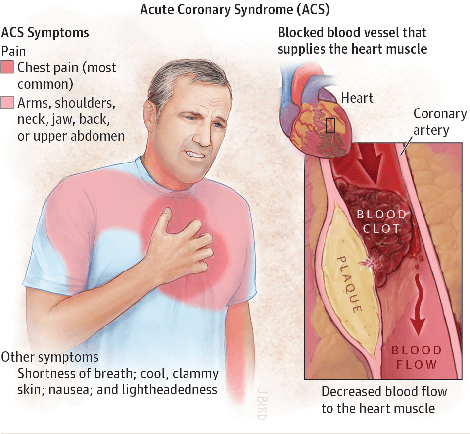 Procalcitonin A New Biomarker For The Cardiologist Biovendor Randd